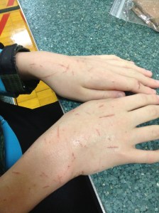 The Boy's hands after he returned from his dad's in January...